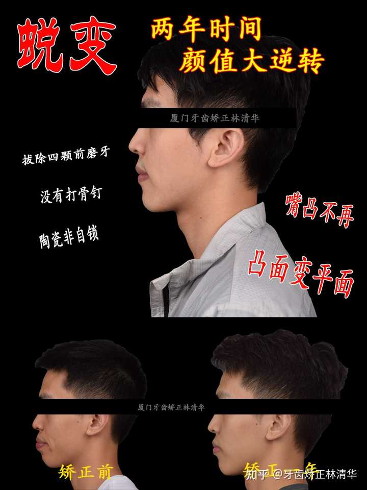 嘴有点凸怎么办? - 知乎
