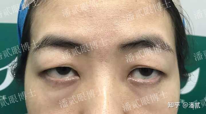 请问下三白眼如何改善呢? - 知乎