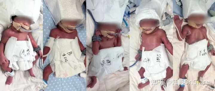 新疆一24 岁产妇诞下 5 胞胎，多胎妊娠会面临哪些挑战？哪种高危妊娠因素最危险？ - 知乎