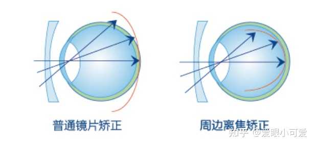 离焦镜是什么原理,真的可以缓解近视吗? - 知乎