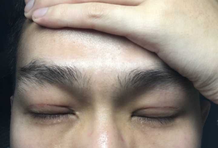 郑大一附院割双眼皮价格_双眼皮的价格_全切双眼皮价格