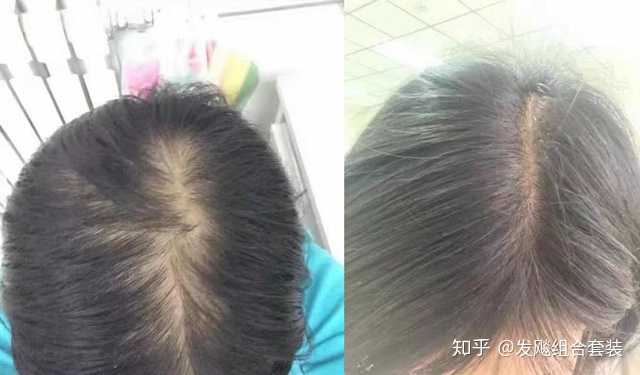 头顶漩涡处头发很少是不是已经开始秃顶了？ - 知乎