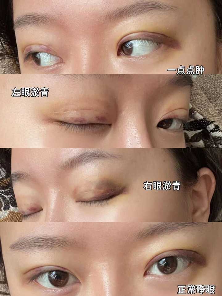 埋线法双眼皮价格_双眼皮埋线价格_双眼皮法埋线价格多少