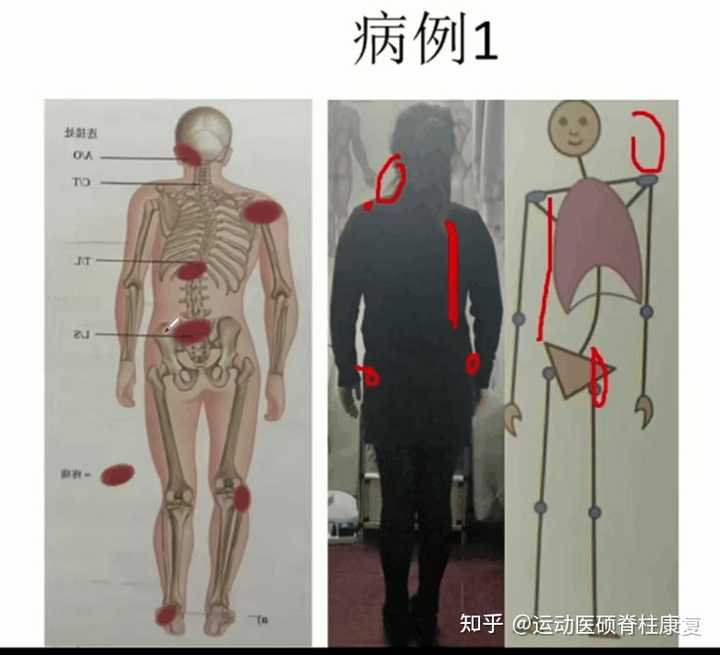 什么运动能解决胸闷背疼? - 知乎