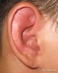 耳带状疱疹常见的症状有哪些？ - 知乎