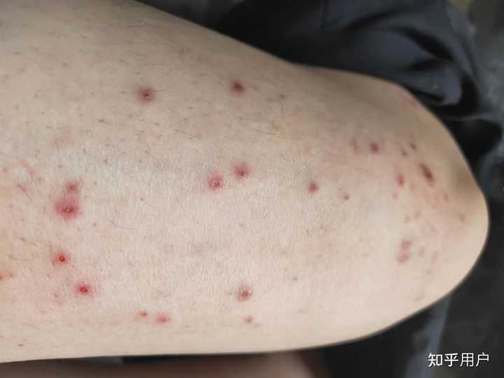 丘疹性荨麻疹多久可以治愈? - 知乎