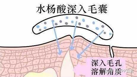 痘印心得经验_痘印心得经验_痘印心得经验
