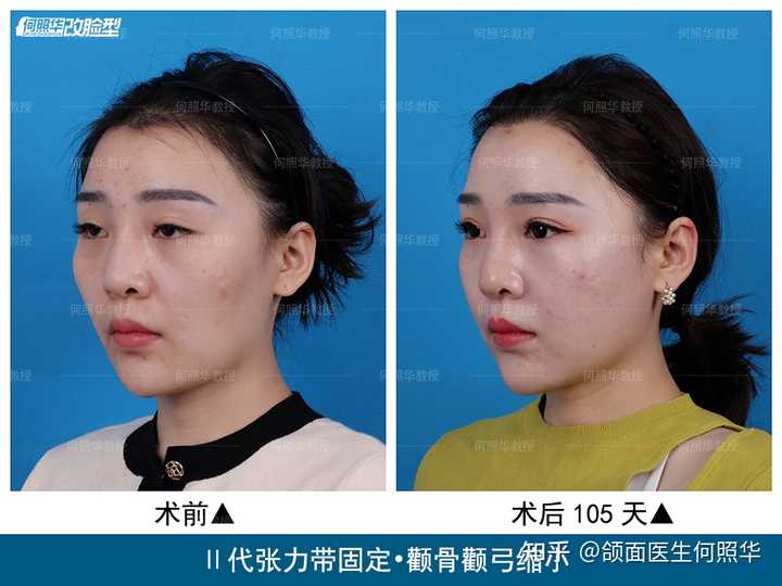 颧骨和颧弓有什么区别,颧弓外扩和颧骨高对脸型分别是什么样的影响? - 知乎