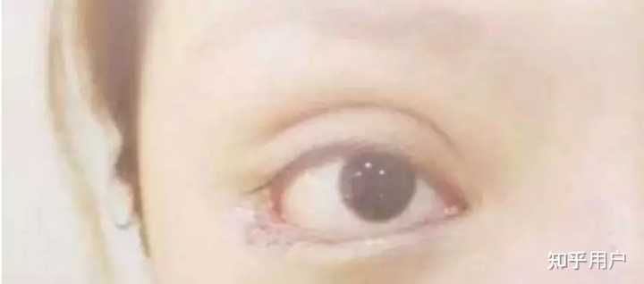 请问下三白眼如何改善呢? - 知乎