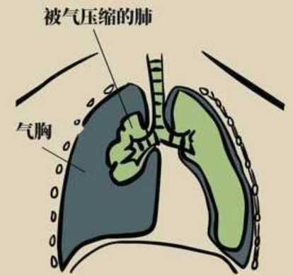 开放性气胸有哪些明显的症状表现？ - 知乎