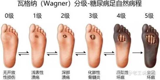 你知道糖足的早期症状吗？ - 知乎