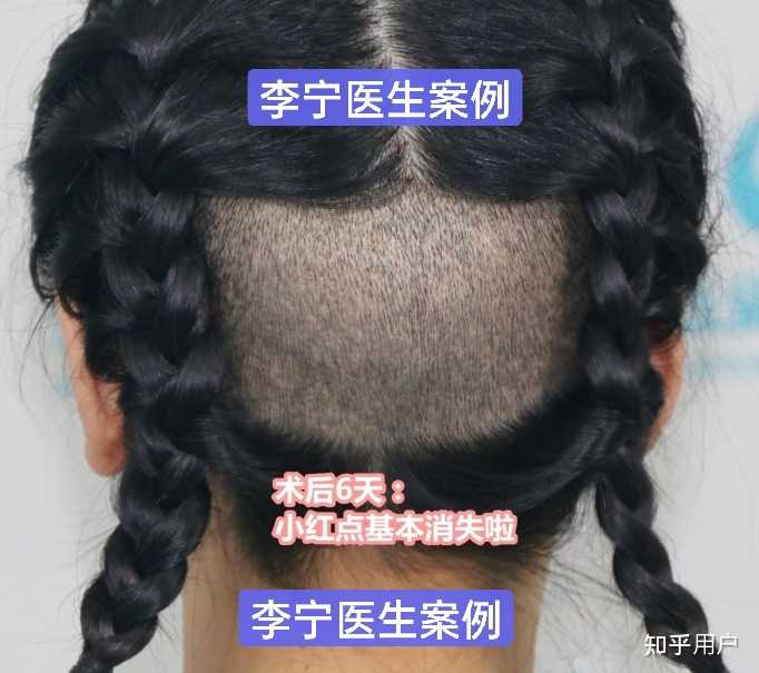 植发后，取发区域几乎没头发了？ - 知乎