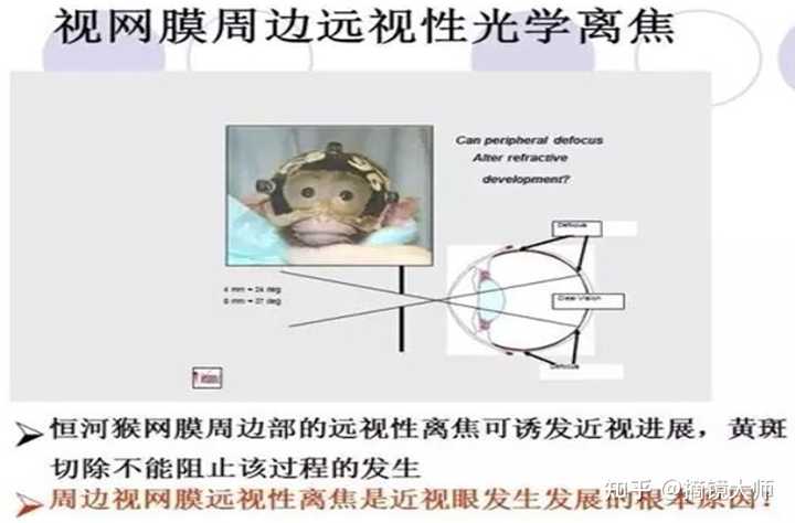 近视离焦为什么可以抑制眼轴增长? - 知乎
