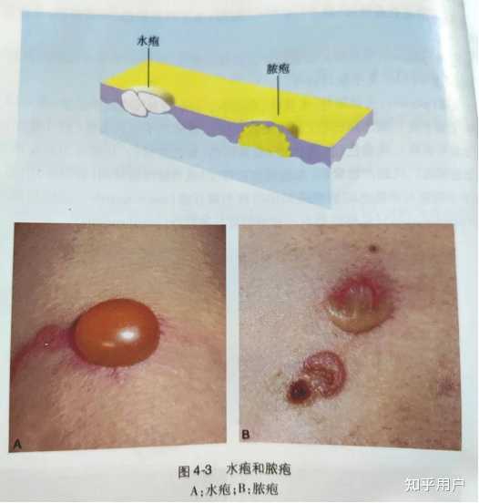 各种皮疹如何区分?例如丘疹、疱疹、荨麻疹、斑疹。 - 知乎