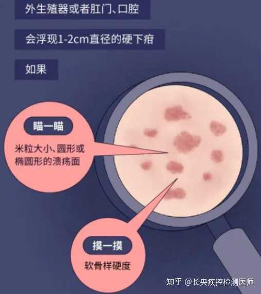 丘疹型梅毒疹? - 知乎