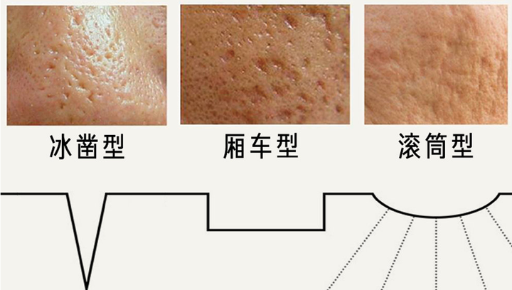 如何去除脸上的痘印、痘坑? - 知乎