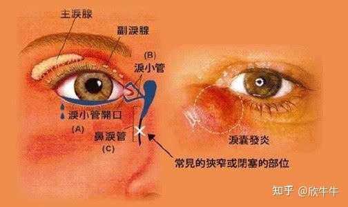 泪囊炎患者会有哪些表现? - 知乎