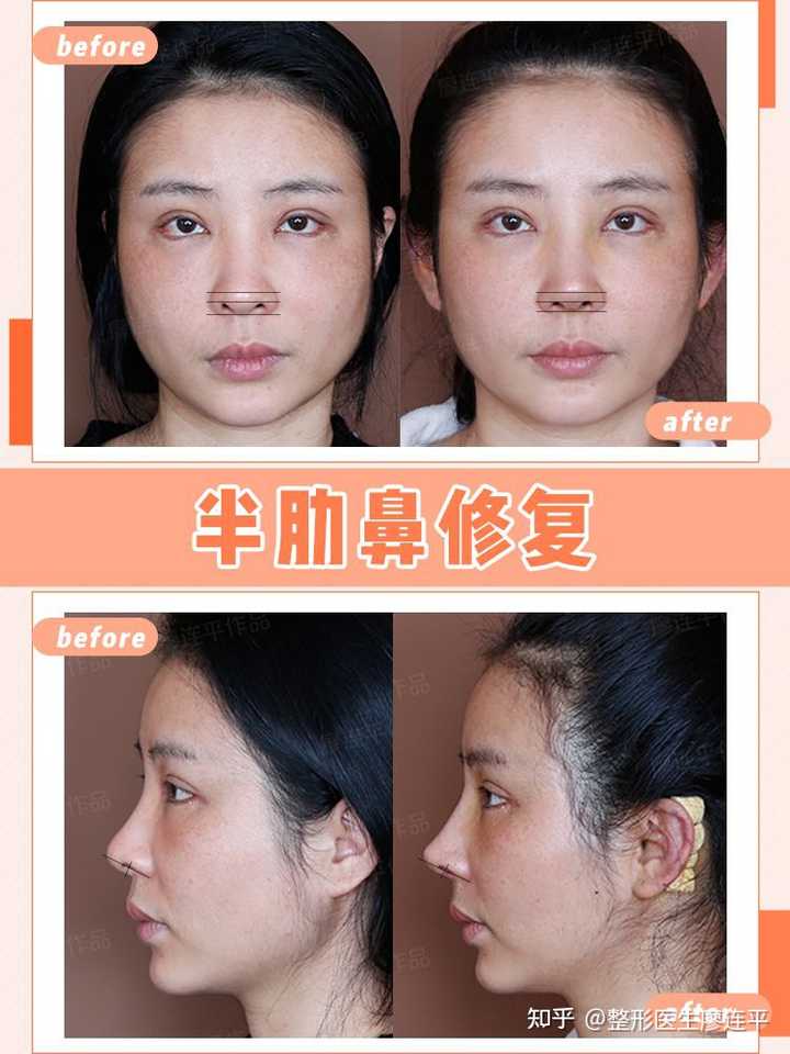 鼻翼缘退缩如何判定? - 知乎