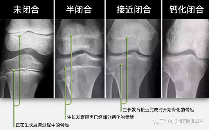 骨骺线闭合之后，还可以通过运动刺激软骨增殖吗？ - 知乎