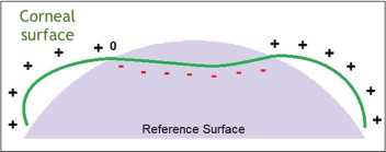 为什么超声角膜测厚检查怎么看角膜地形图呢？？_https://www.jmylbn.com_新闻资讯_第11张