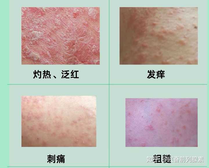 这是什么疹子啊?摸着圆圆的,中间凹下去一点点? - 知乎