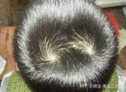 我的这个发旋处的发量是正常的吗？ - 知乎
