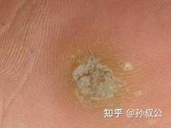 如何有效的治疗刺猴呢? - 知乎