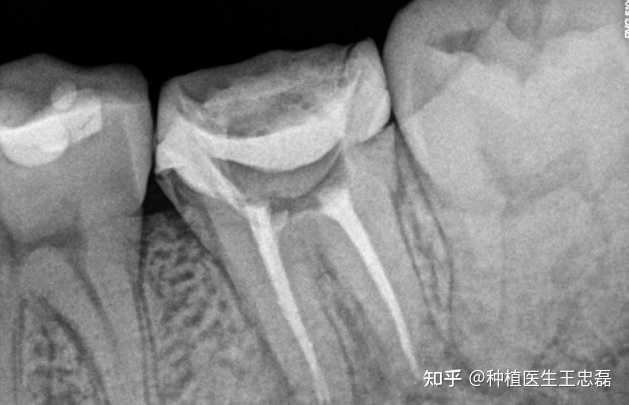 残牙根的危害有什么? - 知乎
