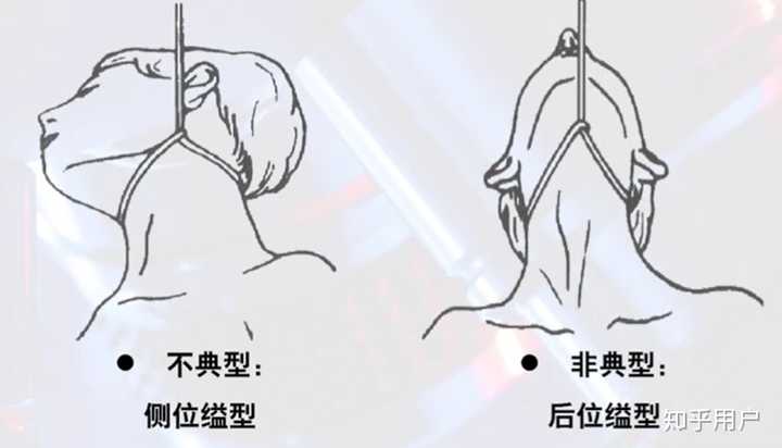 典型缢死和非典型缢死的区别是什么? - 知乎