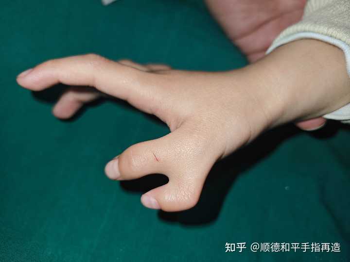 小时候六指手术造成的拇指畸形想考公考编,不知道体检能过么? - 知乎