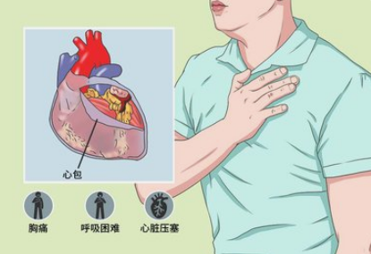 缩窄性心包炎有哪些特别明显的症状表现? - 知乎
