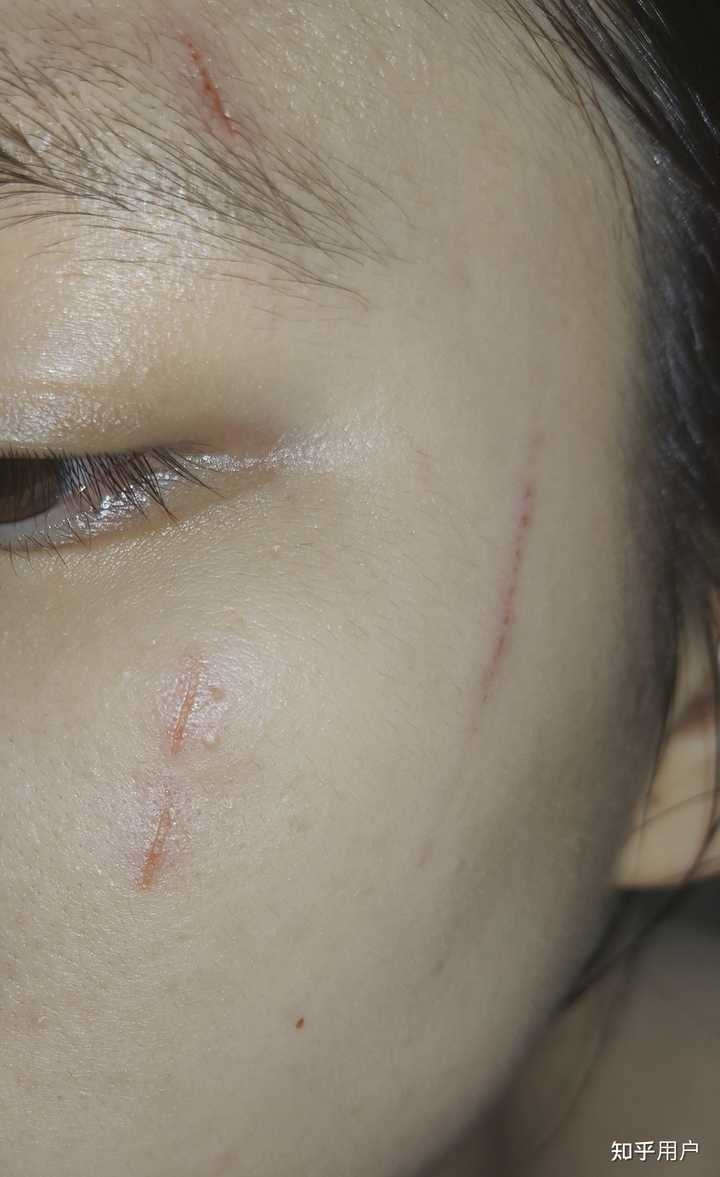 脸被猫抓伤,如何护理不会落疤或印痕? - 知乎
