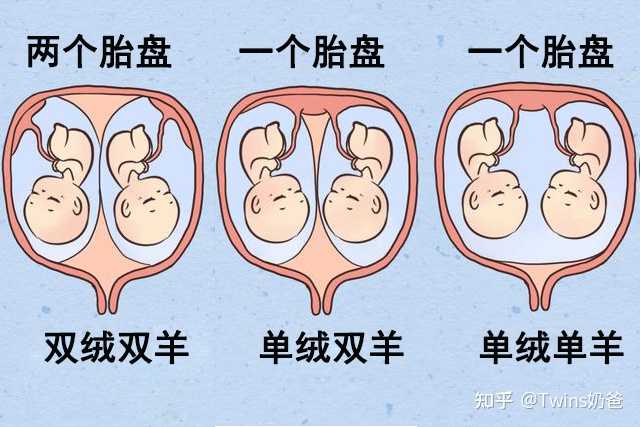怎么判断自己怀的双胞胎是一个胎盘还是两个,是双绒双羊还是单绒双羊? - 知乎