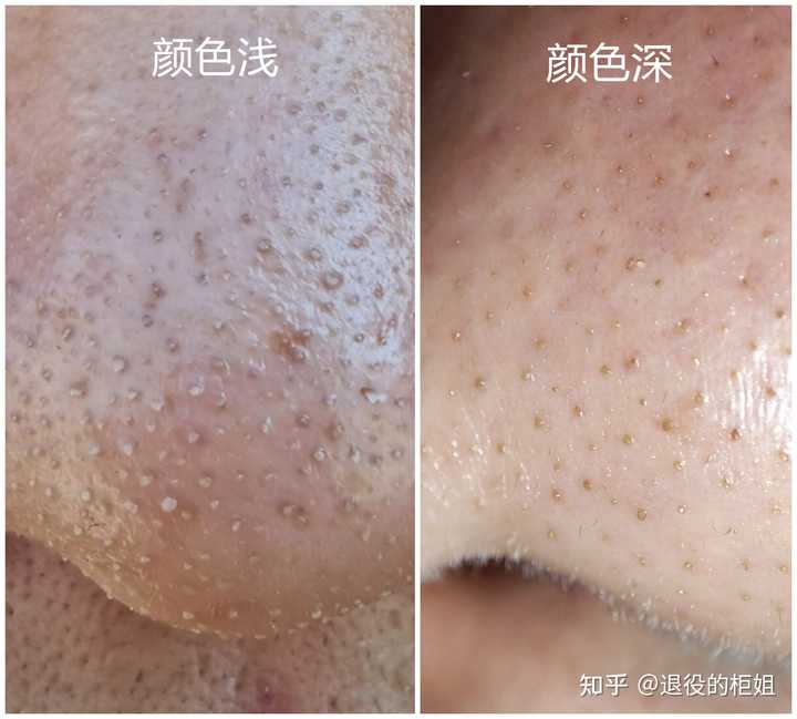 黑头与暗疮之间有什么区别？ - 知乎