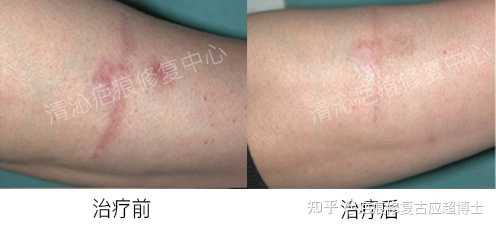 脸上缝针疤痕怎么去除 知乎