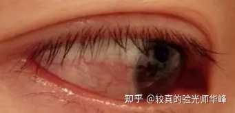 眼睛通红可能是哪些原因导致? - 知乎