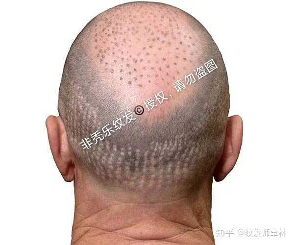 纹发靠谱吗？纹发有副作用吗？ - 知乎