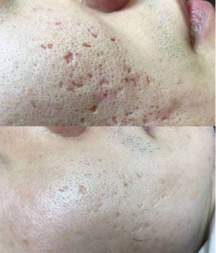 点阵激光能够修复到正常人水平吗