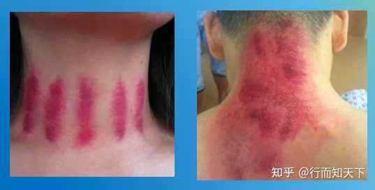 刮痧究竟是什么？从现代医学讲有科学依据么？痧又是什么客观物质？ - 知乎