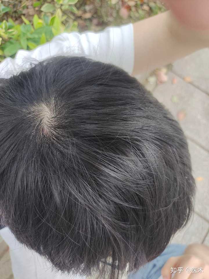 我头旋处头发正常吗? - 知乎