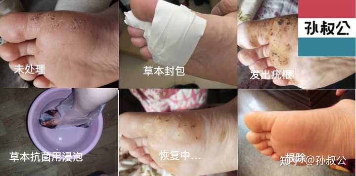 脚上长了血胞刺怎么办? - 知乎