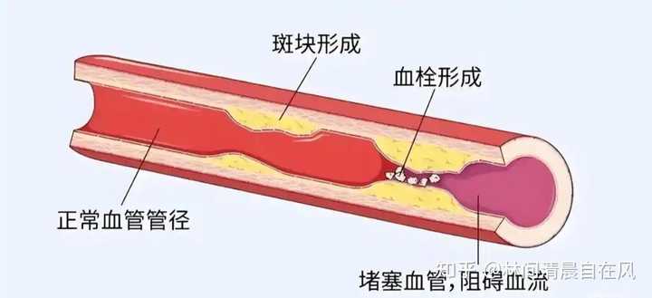 血栓有什么症状和预兆？ - 知乎