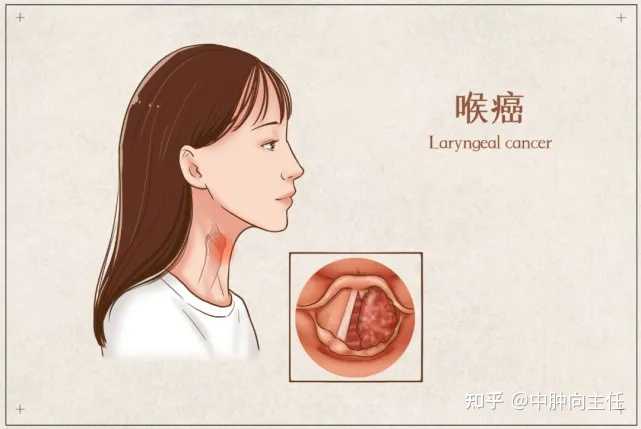 喉癌的早期症状和前兆是什么? - 知乎
