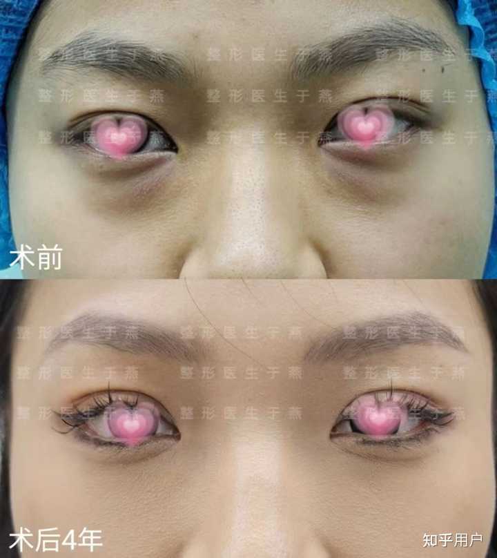 做完眶隔释放一两年以上的你觉得效果如何？ - 知乎