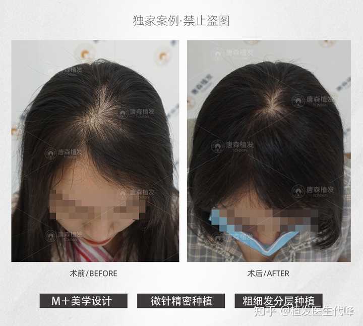 女生的发缝越来越宽怎么办?除了植发还有别的方法吗? - 知乎