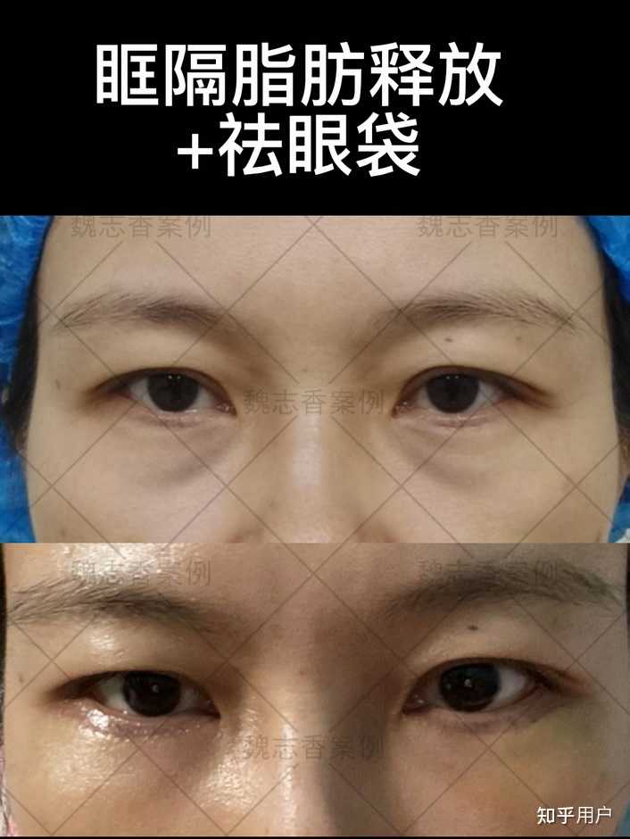 做完眶隔释放一两年以上的你觉得效果如何？ - 知乎