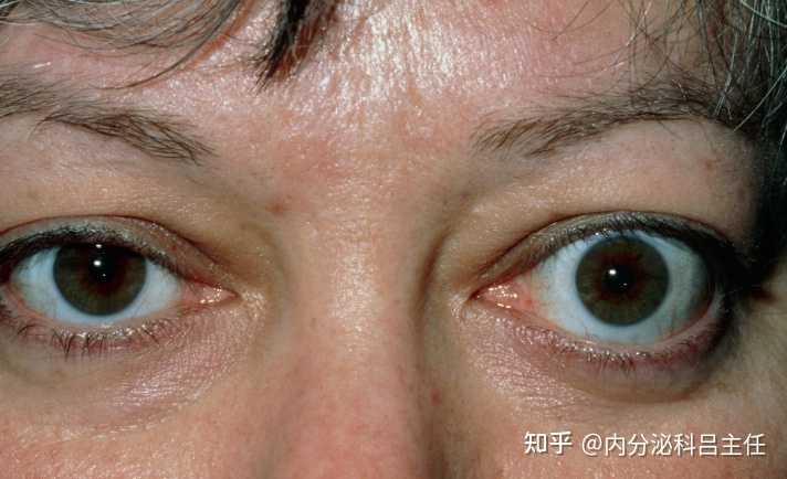 甲亢早期如何保护自己,让甲亢对眼睛的伤害降到最低? - 知乎