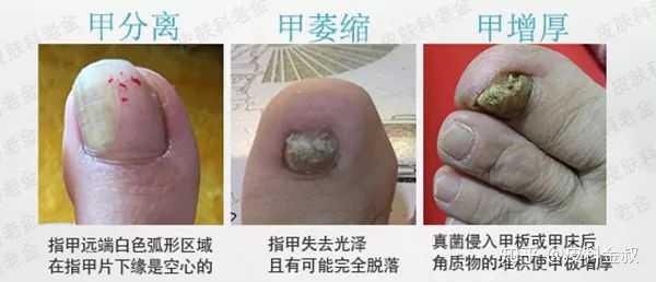 灰指甲变厚是什么真菌感染呢? - 知乎
