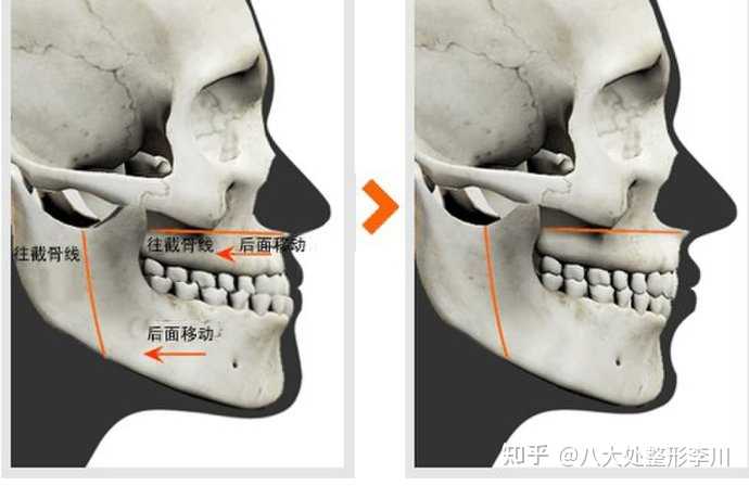 偏颌与反颌会不会越来越严重,该不该做正颌手术? - 知乎