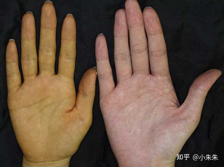 皮肤发黄的原因有哪些？ 知乎